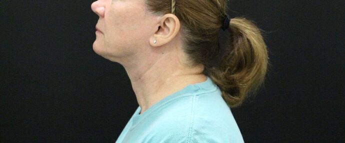 Face & Neck Lifts: Case 9 - After