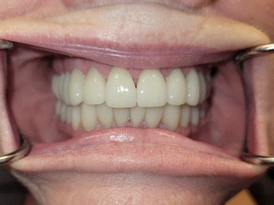 Dental Crowns Case 2 - After