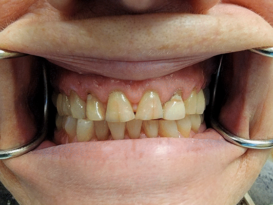 Dental Crowns Case 2 - Before