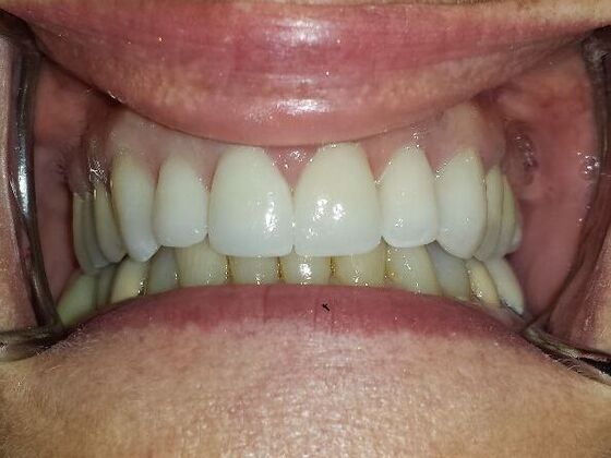 Dental Crowns Case 3 - After