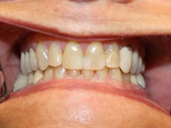 Dental Crowns Case 3 - Before