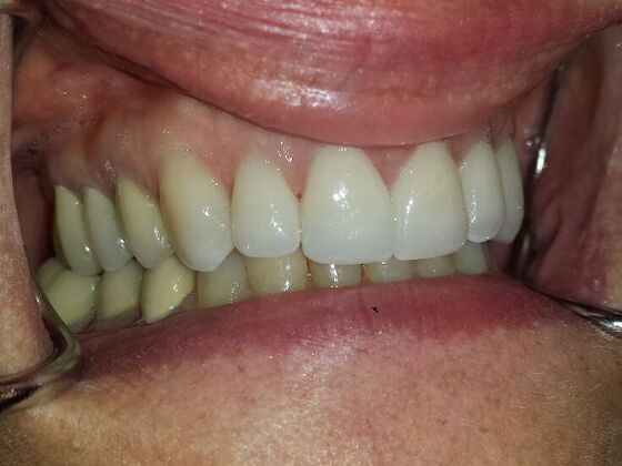 Dental Crowns: Case 3 - After