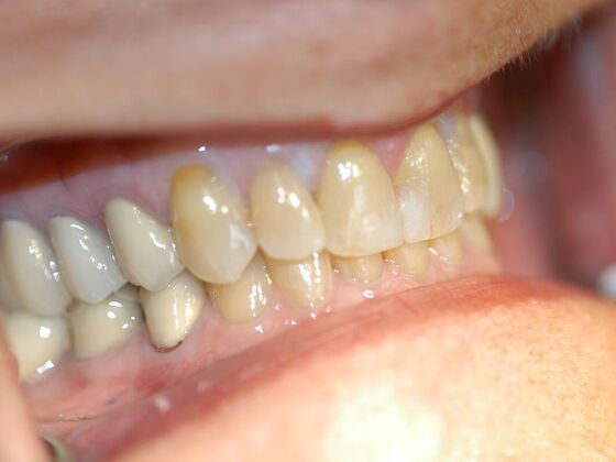 Dental Crowns: Case 3 - Before
