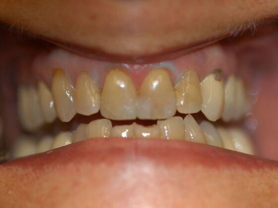 Dental Crowns: Case 3 - Before