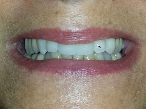 Dental Crowns: Case 3 - After