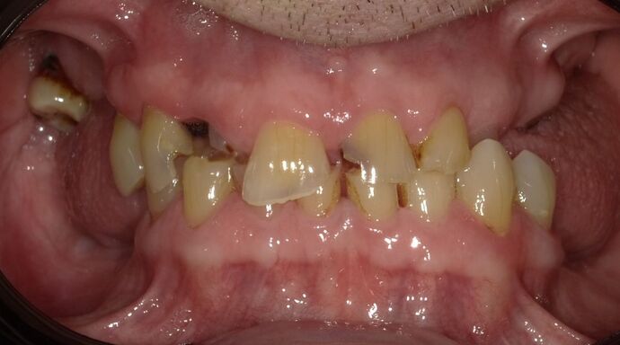 Dental Implant Dentures: Case 5 - After