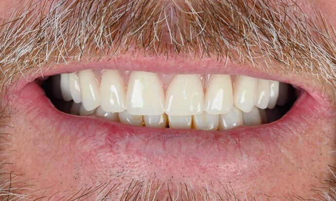 Dental Implant Dentures: Case 5 - Before