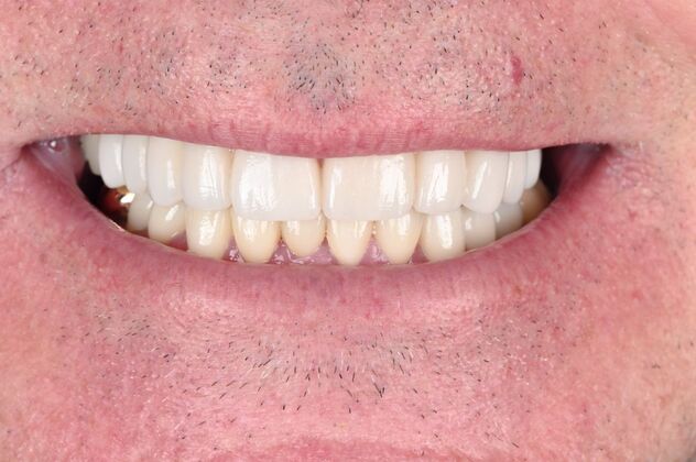 Full Mouth Rehabilitation Case 5 - After