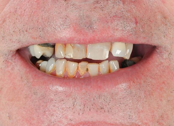 Full Mouth Rehabilitation Case 5 - Before