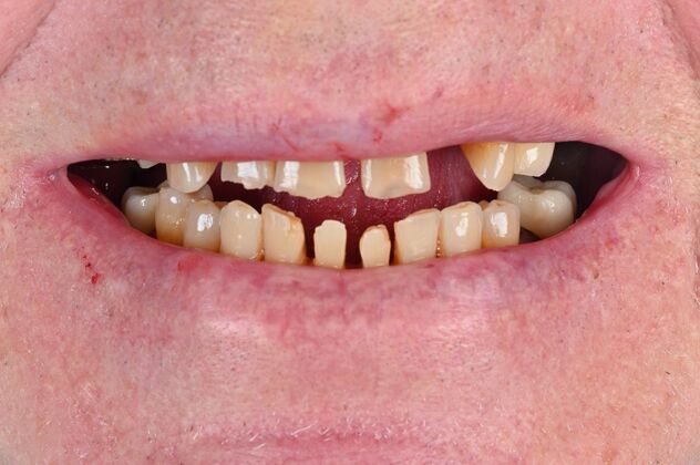 Full Mouth Rehabilitation Case 6 - Before