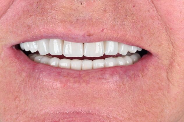 Full Mouth Rehabilitation Case 6 - After