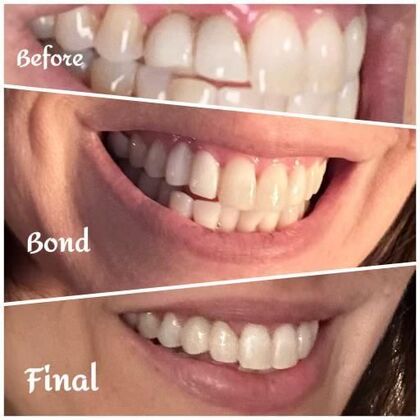 Cosmetic Bonding Gena L. - Before