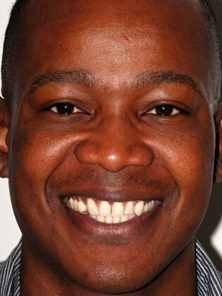 Cosmetic Bonding Rich S.  - Before