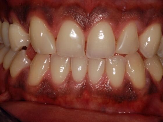 Cosmetic Bonding: Rich S. - Before