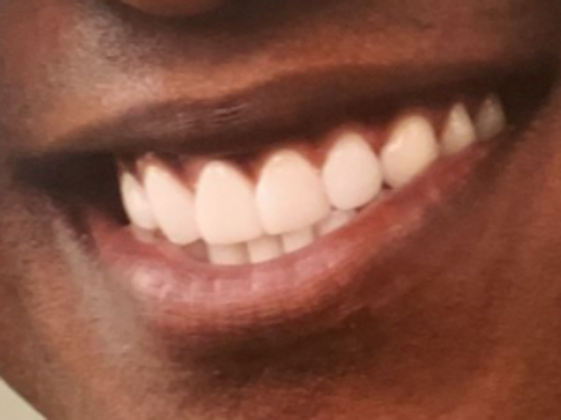 Cosmetic Bonding: Rich S. - After