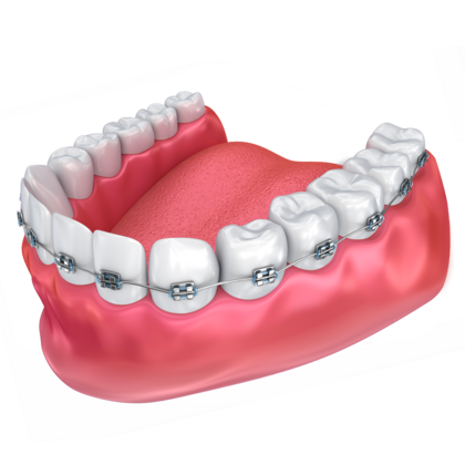 Braces Case