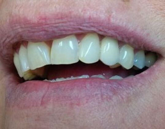 Dental Implants: Patient 4 - After and Implant-Supported Crown