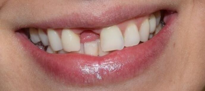 Dental Implants: Patient 5 - Before an Implant-Supported Crown
