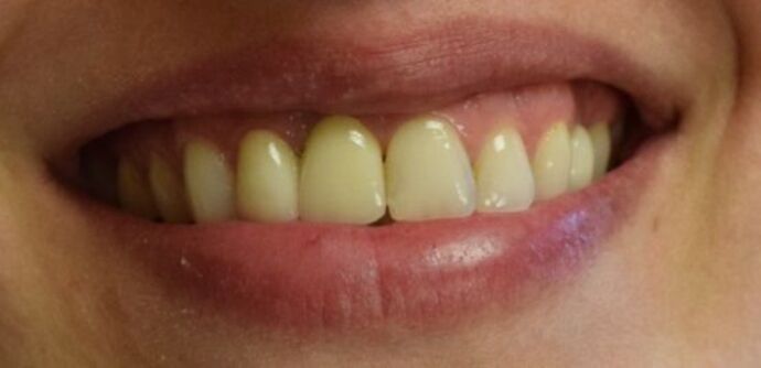 Dental Implants: Patient 5 - After an Implant-Supported Crown
