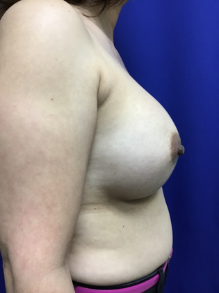 Breast Augmentation : Case 82 (179457) - After