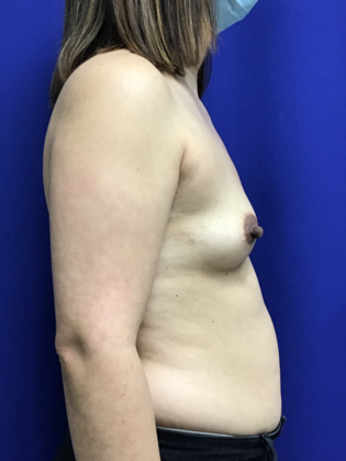 Breast Augmentation : Case 82 (179457) - Before