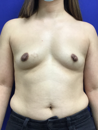 Breast Augmentation : Case 82 (179457) - Before