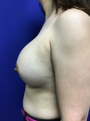 Breast Augmentation : Case 82 (179457) - After