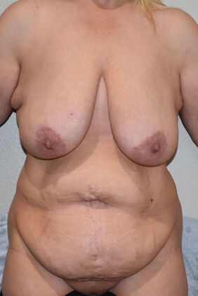 Mommy Makeover Case 263 - Before