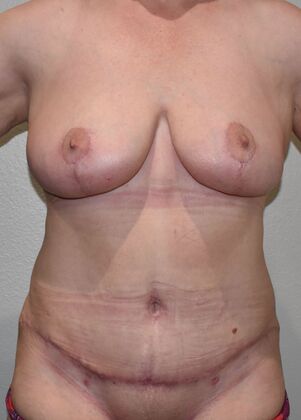 Mommy Makeover Case 263 - After