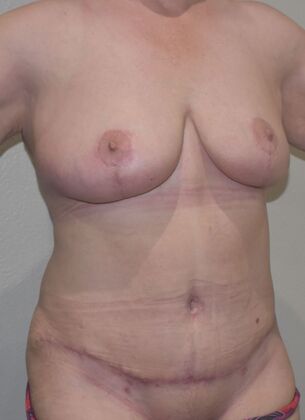 Massive Weight Loss : Case 126 - After