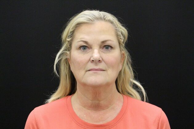 Face & Neck Lifts Case 1 - Before