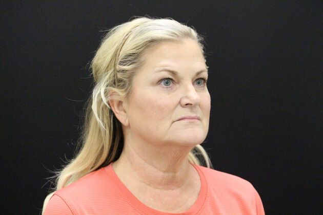 Face & Neck Lifts: Case 1 - Before