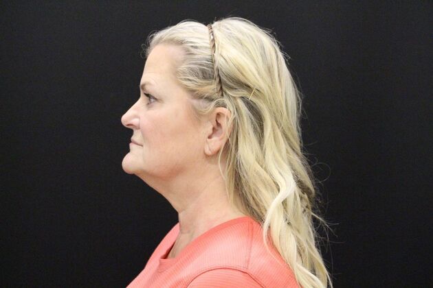Face & Neck Lifts: Case 1 - Before