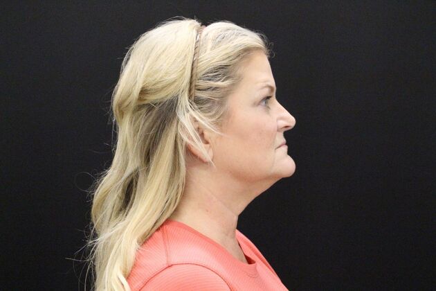Face & Neck Lifts: Case 1 - Before