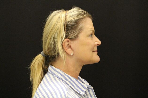 Face & Neck Lifts: Case 1 - After