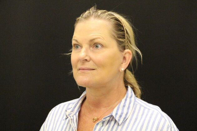 Face & Neck Lifts: Case 1 - After