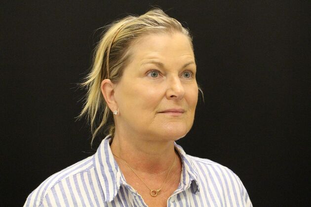 Face & Neck Lifts: Case 1 - After