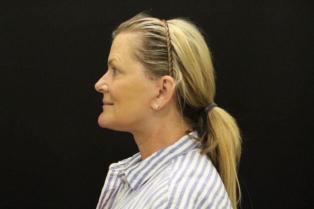 Face & Neck Lifts: Case 1 - After