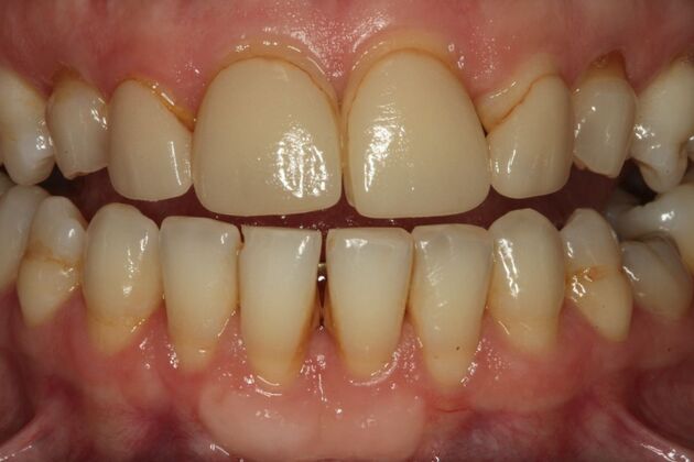 Dental Implants Case 7 - Before