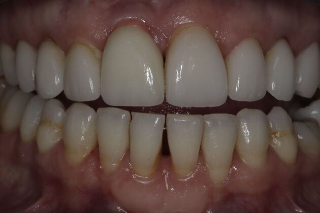 Dental Implants Case 7 - After