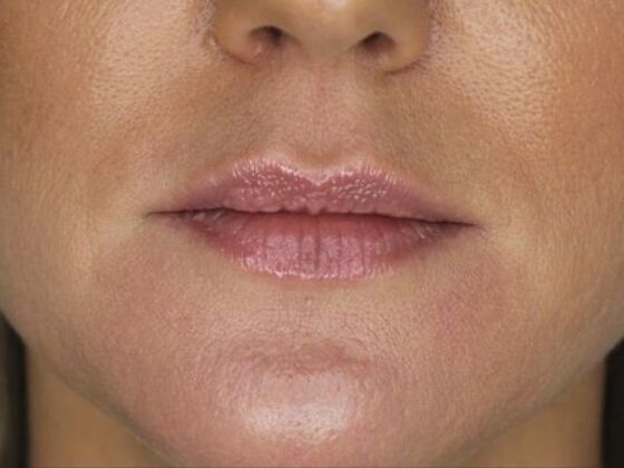 Injectables Case 37 - Before