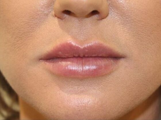 Injectables Case 37 - After