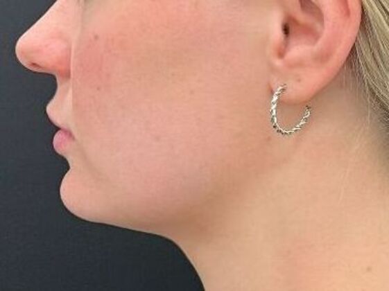 Injectables Case 38 - Before