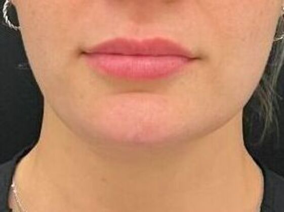 Injectables: Case 38 - Before