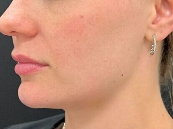 Injectables: Case 38 - Before