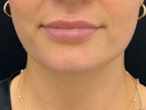 Injectables: Case 38 - After