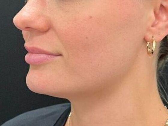 Injectables: Case 38 - After