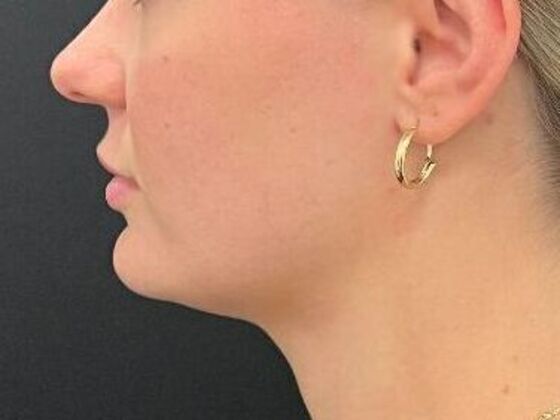 Injectables Case 38 - After