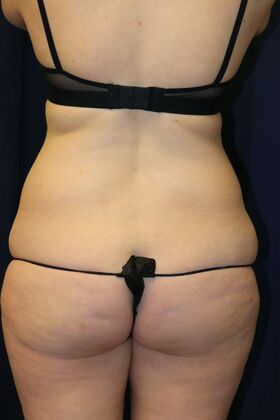 Liposuction & Safe Lipo Case 53 - Before
