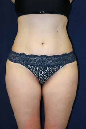 Liposuction & Safe Lipo: Case 53 - After